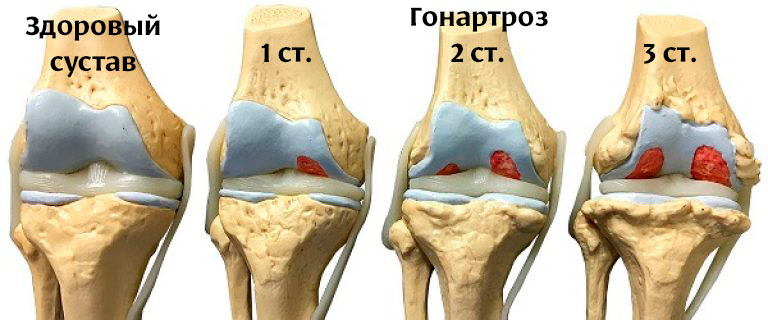 стадии артроза