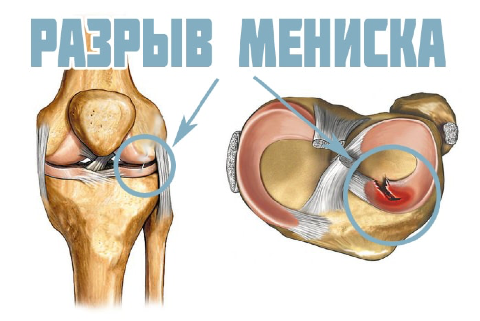 разрыв мениска