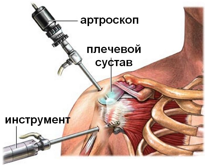 артроскопия плеча