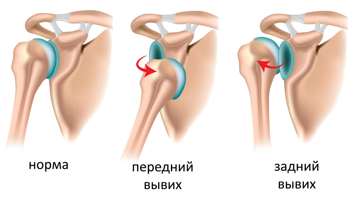 виды вывиха плеча